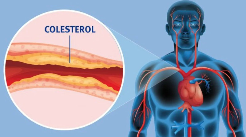 ¿Sabes cuales son los niveles adecuados de colesterol y cómo bajar el colesterol malo?