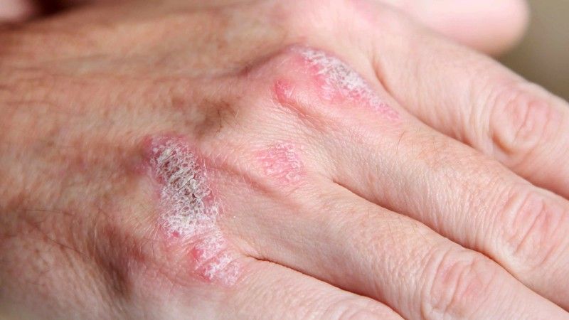 Todo lo que debes saber sobre  la psoriasis. Síntomas y Diagnostico. Causas y Tratamiento
