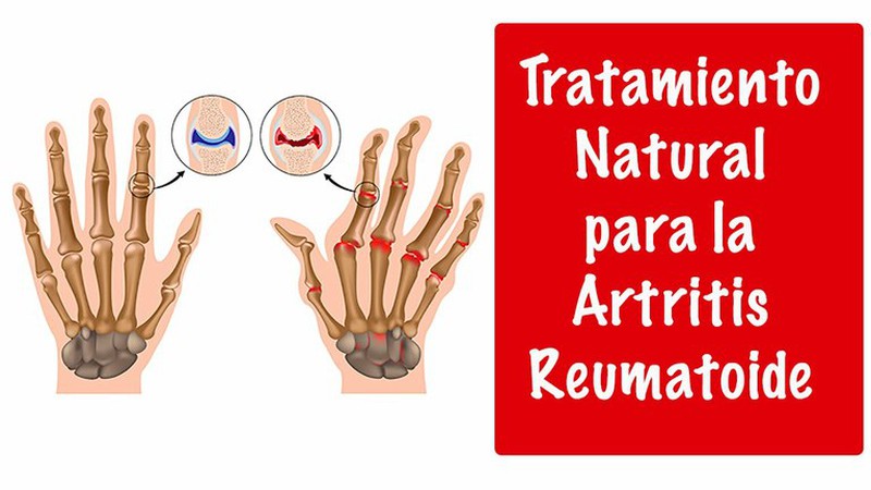 Artritis: tractament natural