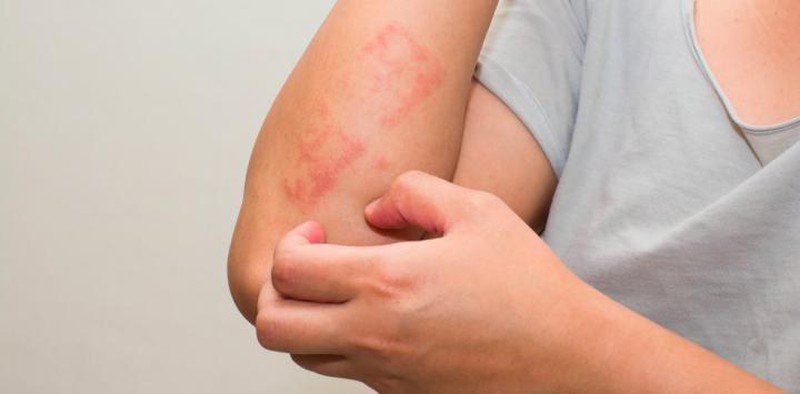 ¿Qué es es bueno para la psoriasis?