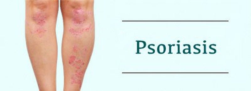 El mejor tratamiento para la psoriasis