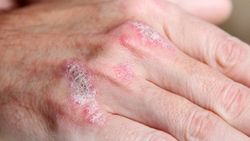 Com es pot fer desaparèixer la psoriasi a la pell?